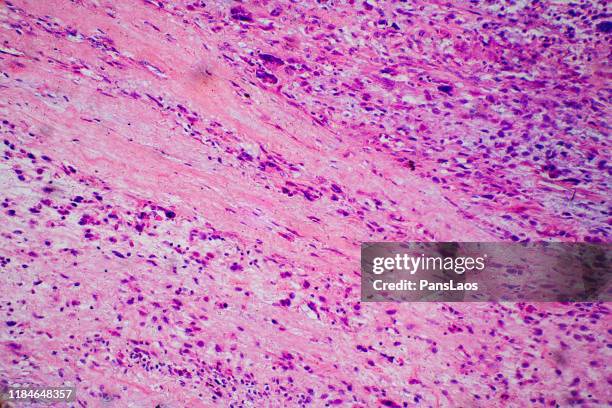 human medical cancer cells skeletal muscle tumor - sistema linfatico foto e immagini stock