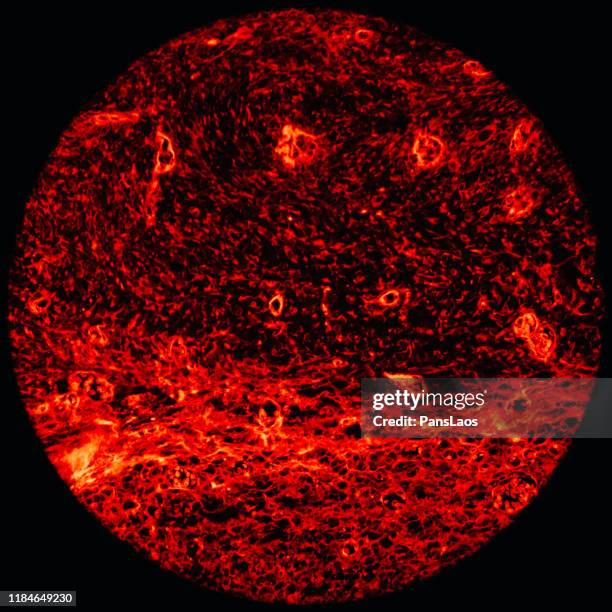 skeletal muscle tumor cells of human under microscope fluorescence - skeletal muscle stock pictures, royalty-free photos & images