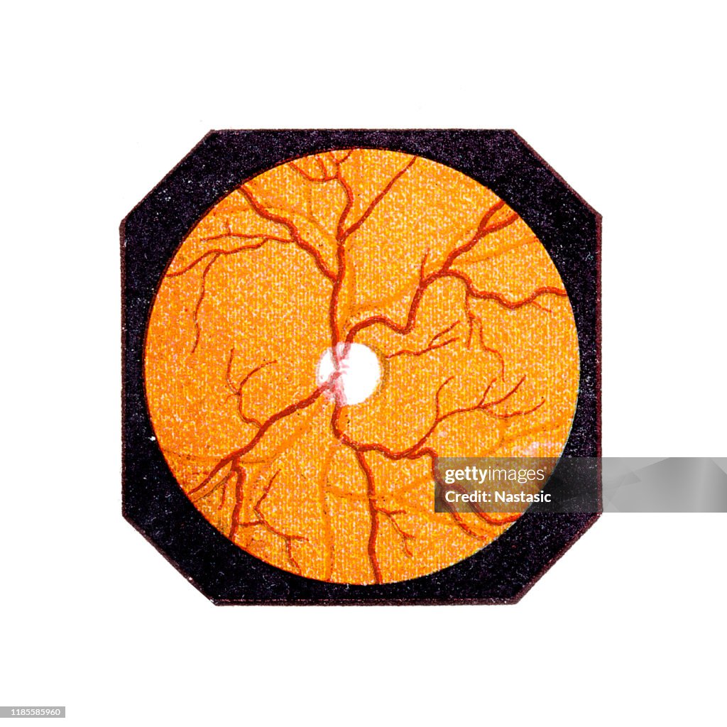 Optic nerve atrophy