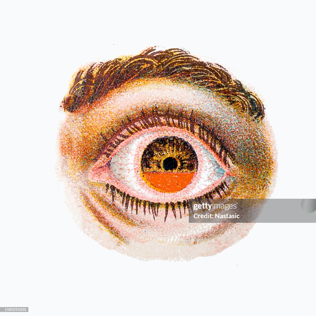 Hyphaema