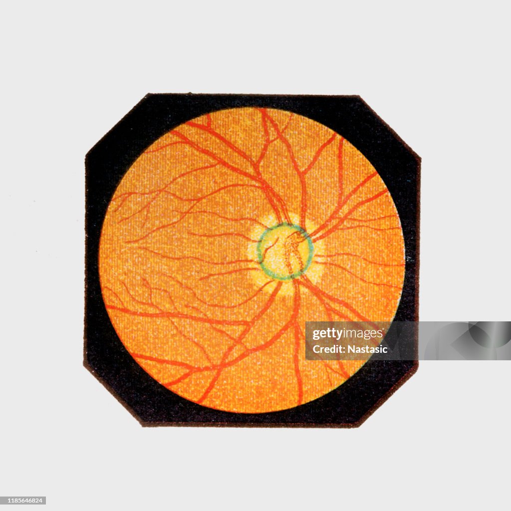 Glaucoma (internal view)