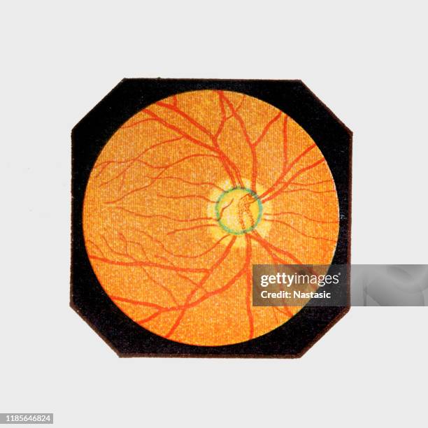 glaucoma (internal view) - optic nerve stock illustrations