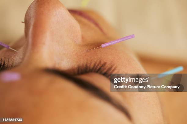 young woman lying on a bed during an acupuncture session - acupuncture needle stock pictures, royalty-free photos & images