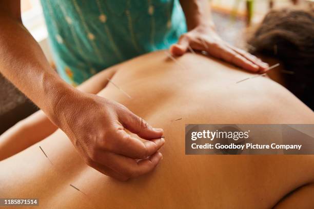 alternative therapist preforming acupuncture on a female patient's back - acupuncture needle stock pictures, royalty-free photos & images