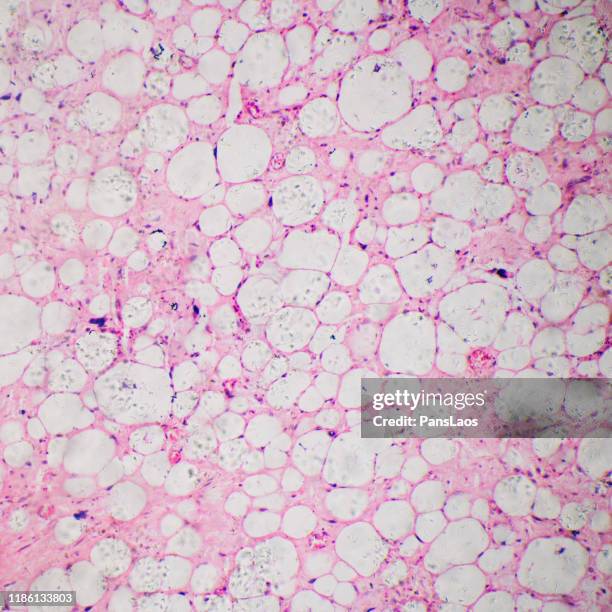 micrograph of liposarcoma human cells - lâmina de microscópio - fotografias e filmes do acervo
