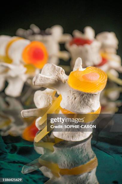 vertebrae and discs. neurodegenerative disease. - decompression sickness stock pictures, royalty-free photos & images