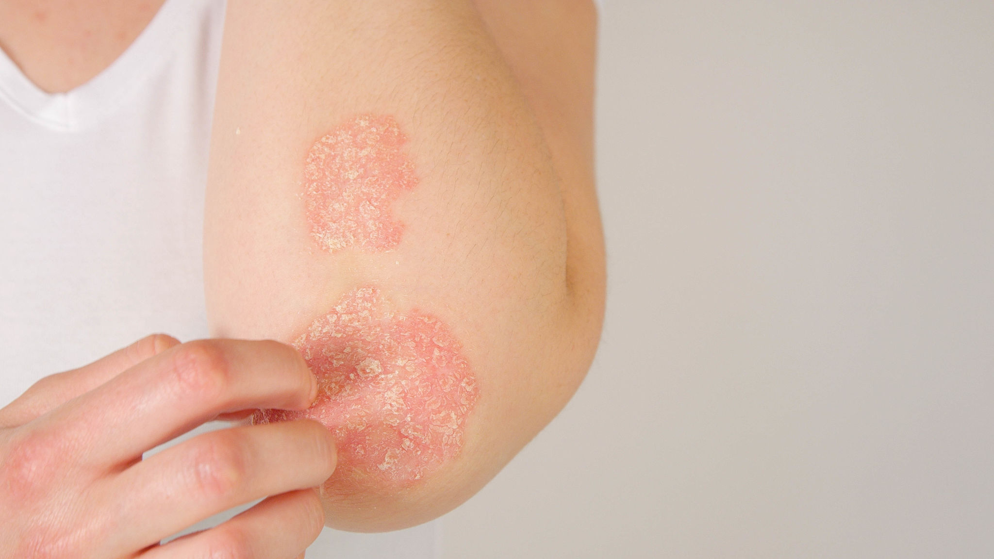 psoriasis symptoms