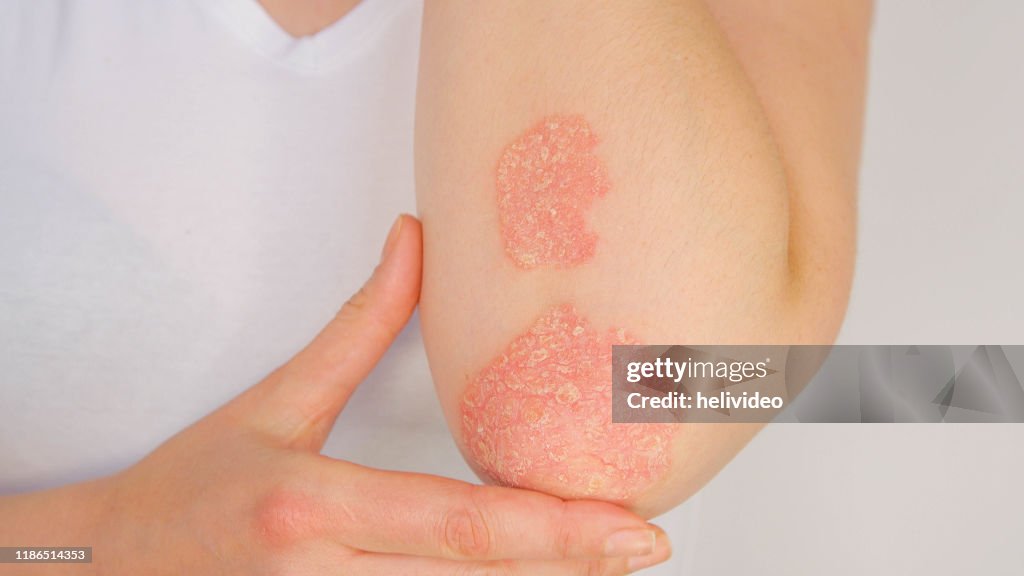 Posiatic Rash Close Up Woman With Big Red Scaly Rash Suffering From Elbow Psoriatic ...