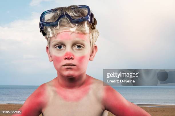 menino queimado de sol - queimadura pele - fotografias e filmes do acervo