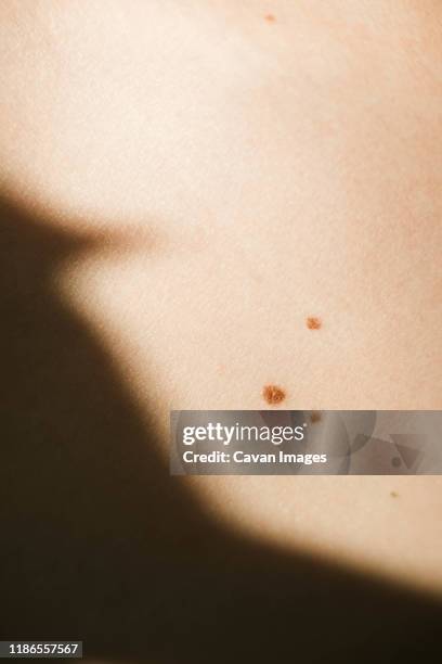 closeup view shot of skin with birthmarks - mole stock pictures, royalty-free photos & images