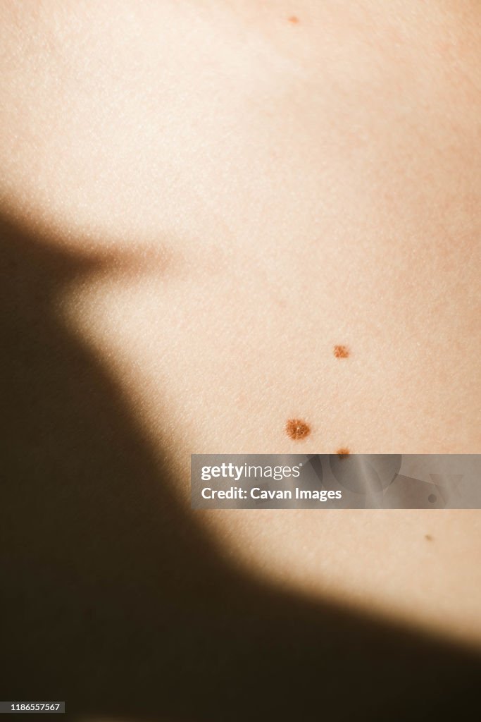 Closeup view shot of skin with birthmarks