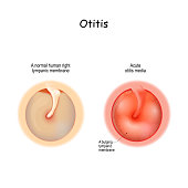 Healthy membrane, and bulging tympanic membrane of Acute otitis media