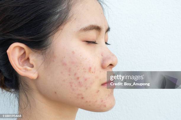 side view of woman half face with problems of acne inflammation (papule and pustule) on her cheek. - ugly face 個照片及圖片檔