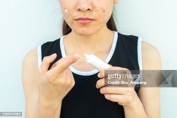 cropped shot of woman half face with acne inflammation (papule and pustule) on her face and she holding cosmetic tube for applying acne cream on her face for treat. - creme tube ストックフォトと画像