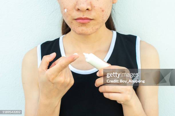 cropped shot of woman half face with acne inflammation (papule and pustule) on her face and she holding cosmetic tube for applying acne cream on her face for treat. - pimple stock pictures, royalty-free photos & images