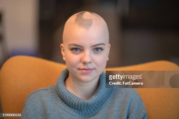 young woman with alopecia sitting stock photo - hair loss stock pictures, royalty-free photos & images