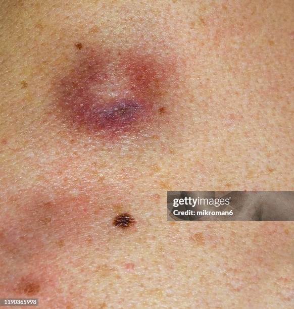 human skin with skin cancer, beauty mark, freckles - cancerland 2019 bildbanksfoton och bilder