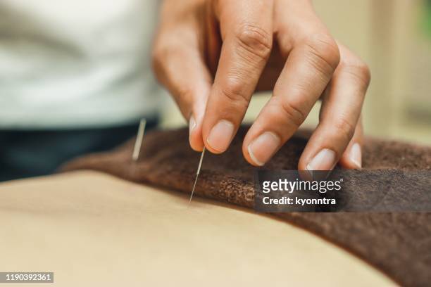 alternatieve geneeskunde die acupunctuur is in azië - acupuncture stockfoto's en -beelden