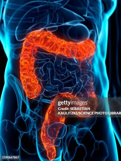 diseased colon, conceptual illustration - ulcerative colitis stock illustrations