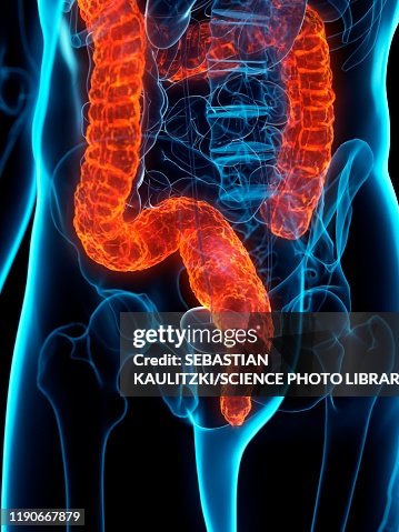 Damage Colon Diseased Colon Conceptual Illustration High-Res Vector Graphic - Getty ...