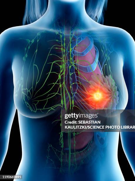 breast cancer, conceptual illustration - lymphatic system stock illustrations