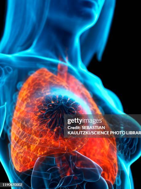 diseased lung, illustration - copd stock illustrations
