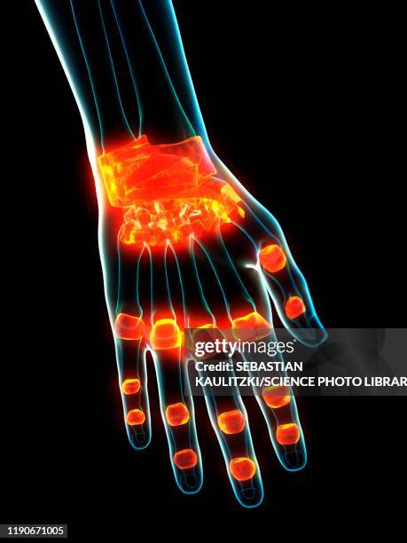 Inflamd 69 Inflamed Ligaments High Res Illustrations - Getty Images