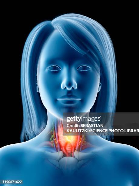 stockillustraties, clipart, cartoons en iconen met thyroid cancer, conceptual illustration - human body part