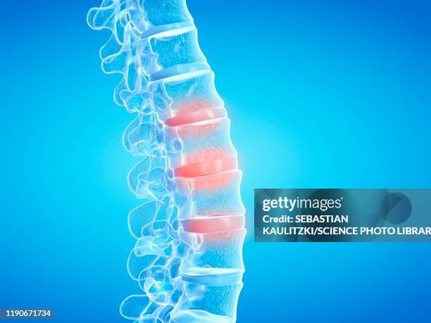 back pain, conceptual illustration - scoliosis stock illustrations