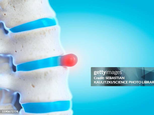 prolapsed spinal disc, illustration - spine disc stock illustrations