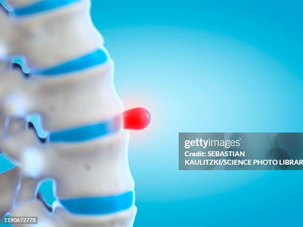 prolapsed spinal disc, illustration - disc prolapse stock-grafiken, -clipart, -cartoons und -symbole