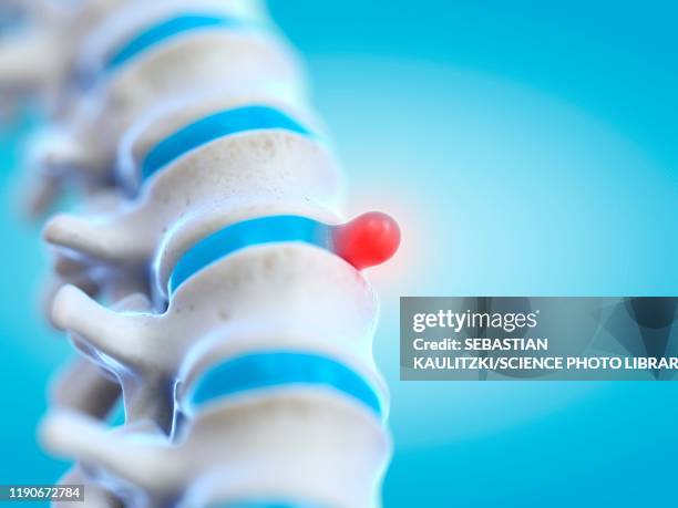 prolapsed spinal disc, illustration - spine disc stock illustrations