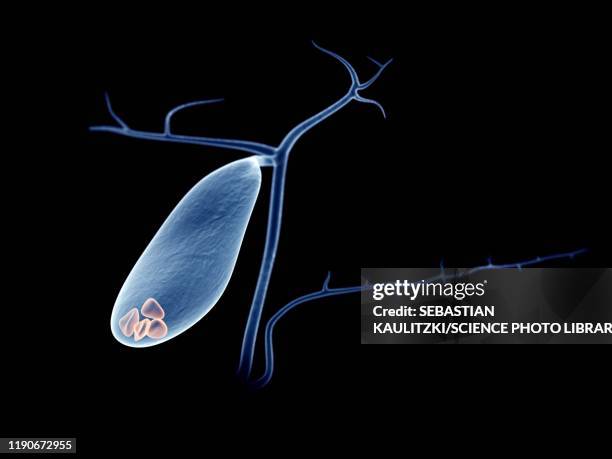 ilustraciones, imágenes clip art, dibujos animados e iconos de stock de gallbladder stones, illustration - vesícula biliar