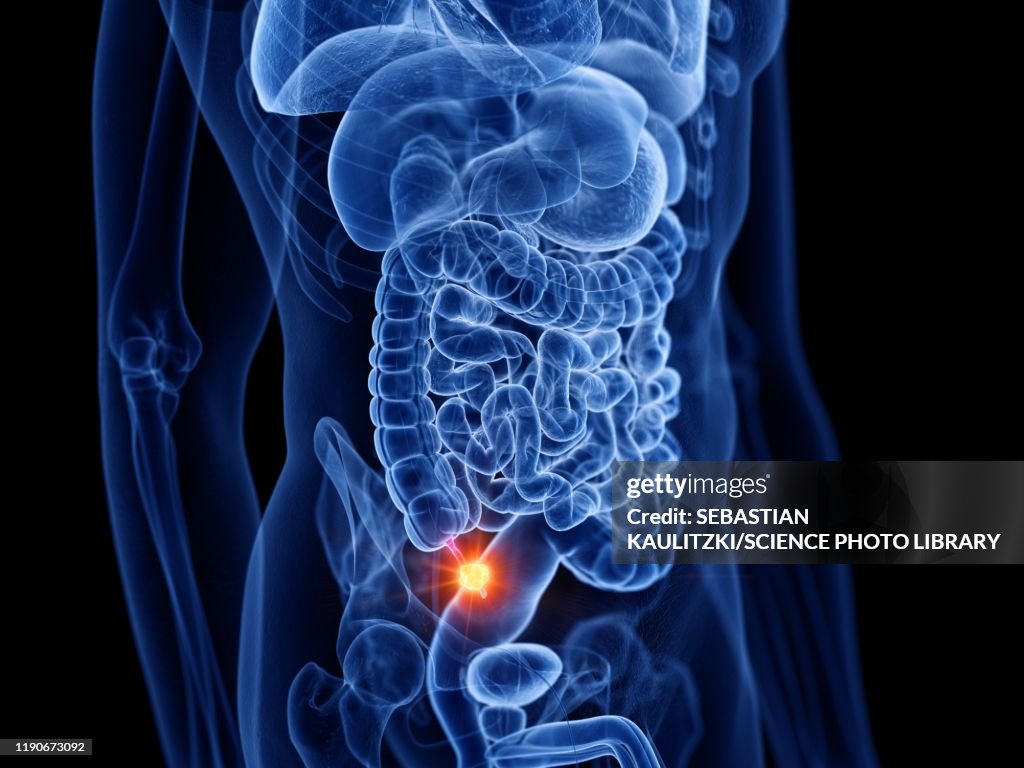 Appendix Cancer Illustration High-Res Vector Graphic - Getty Images