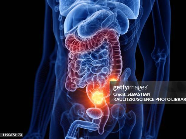 colon cancer, illustration - colon cancer stock illustrations