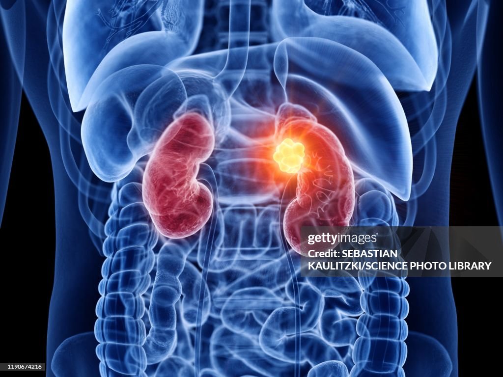 Kidney cancer, illustration