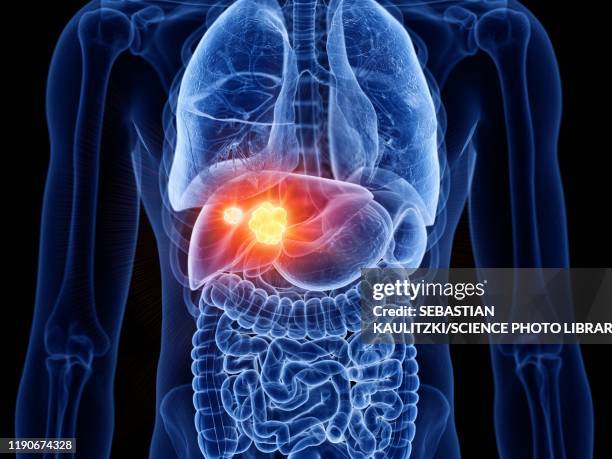 illustrazioni stock, clip art, cartoni animati e icone di tendenza di liver cancer, illustration - tumore metastatico