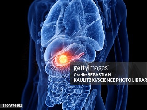 Pancreas Cancer Illustration High-Res Vector Graphic - Getty Images
