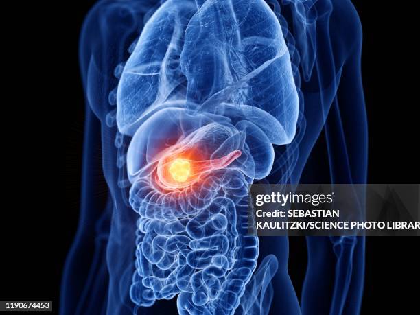 pancreas cancer, illustration - pancreas 3d stock illustrations