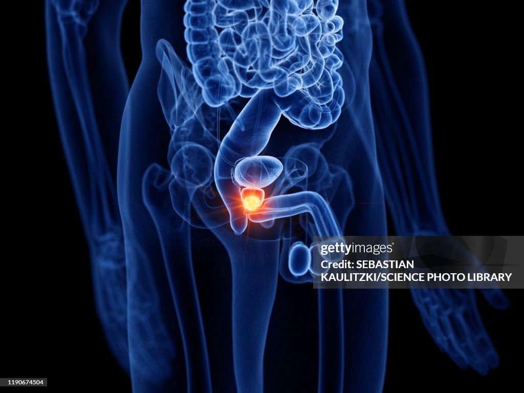 Prostate Cancer Backround Prostate Cancer Illustration High-Res Vector Graphic - Getty Images