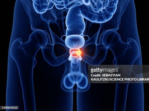 prostate cancer, illustration - metastatic tumour stock-grafiken, -clipart, -cartoons und -symbole