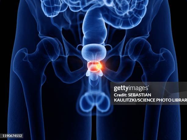 prostate cancer, illustration - metastatic tumour stock illustrations