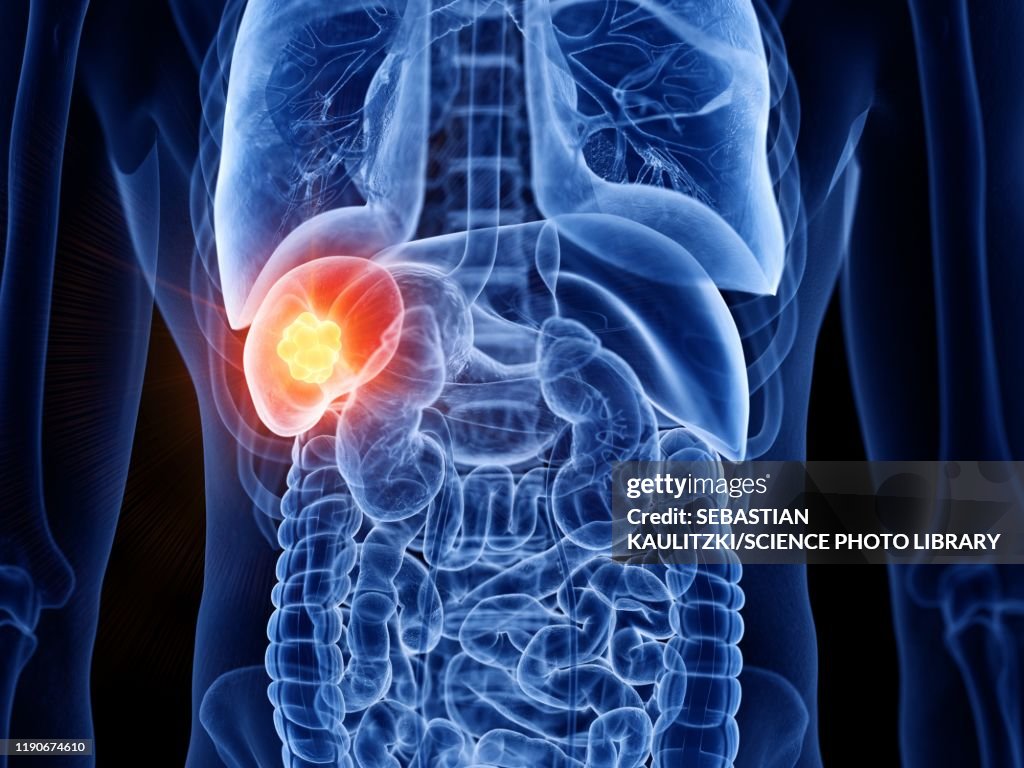 Spleen Cancer Illustration High-Res Vector Graphic - Getty Images