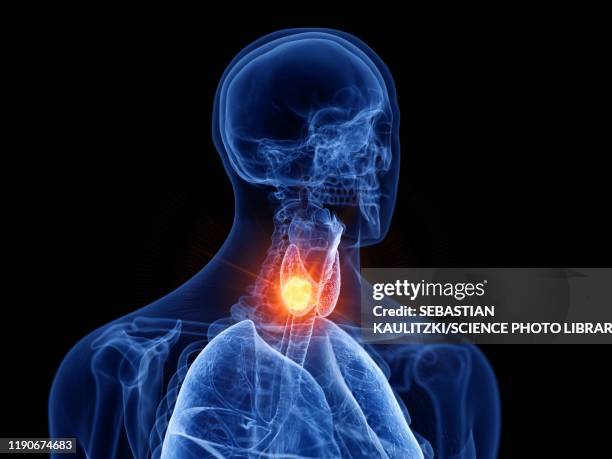 thyroid cancer, illustration - hormones stock illustrations