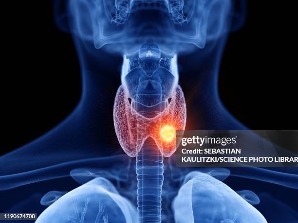 ilustrações, clipart, desenhos animados e ícones de thyroid cancer, illustration - glândula tireoide