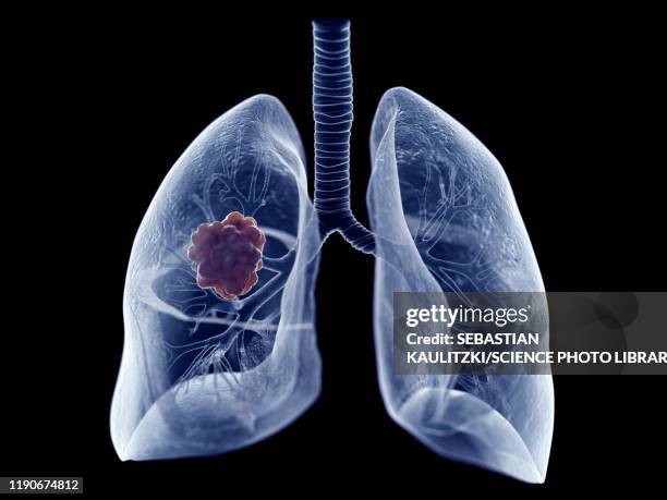 stockillustraties, clipart, cartoons en iconen met lung tumour, illustration - long