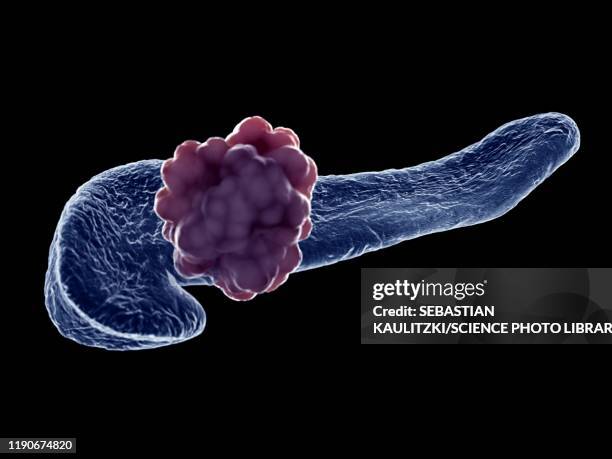 pancreas tumour, illustration - pancreatic cancer stock illustrations
