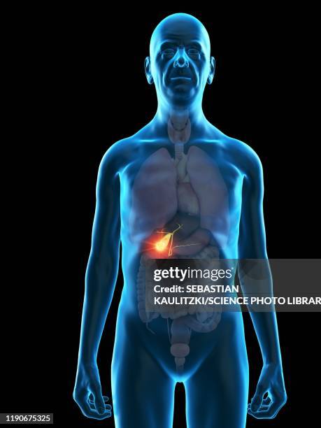 ilustrações de stock, clip art, desenhos animados e ícones de illustration of an old man's gallbladder tumour - bílis