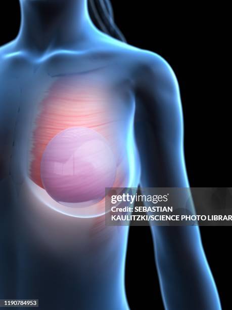 Huge Breast Implants Tumblr