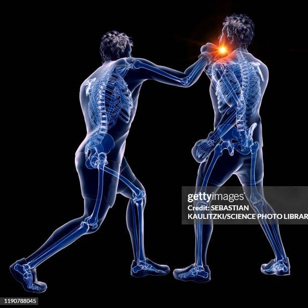 Man With Multiple Injuries Illustrations, cliparts, dessins animés et icônes de Whiplash Injury ...
